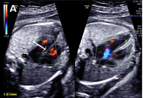 Ultrasound showing Perimembranous VSD