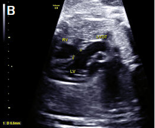 Ultrasound showing Perimembranous VSD