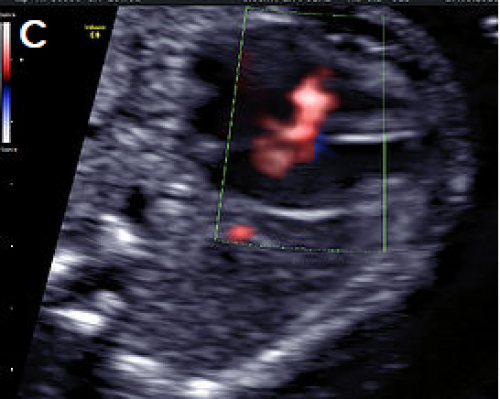 Ultrasound showing Perimembranous VSD