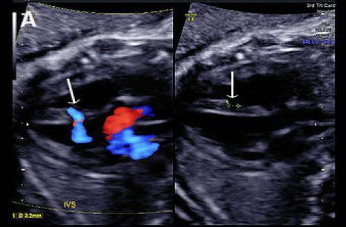 Ultrasound showing muscular VSD