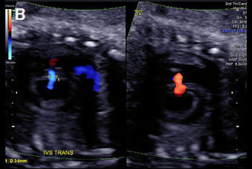 Ultrasound showing muscular VSD