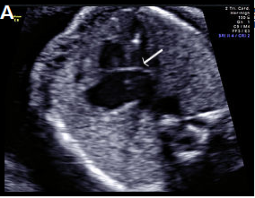 Ultrasound showing atrioventricular septal defect