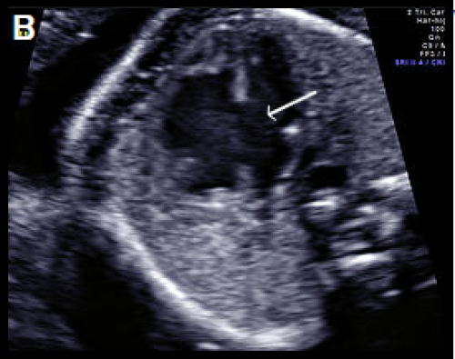 Ultrasound showing atrioventricular septal defect