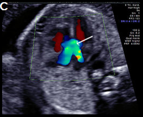 Ultrasound showing atrioventricular septal defect