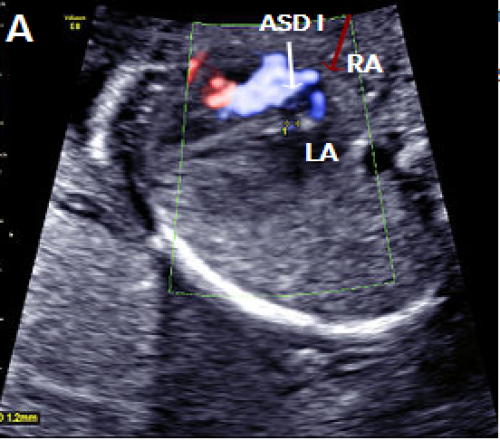 Ultrasound showing other atrial septal defects