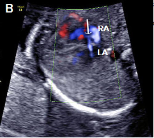 Ultrasound showing other atrial septal defects