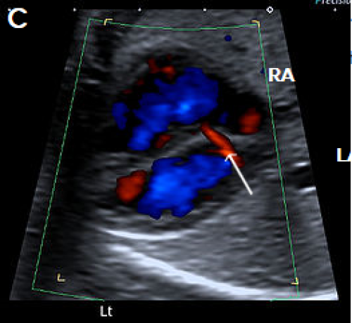 Ultrasound showing other atrial septal defects