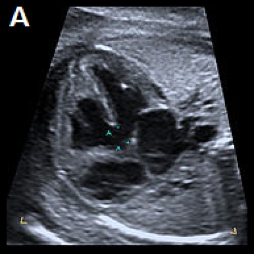 Ultrasound showing Tetralogy of Fallot