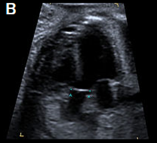 Ultrasound showing Tetralogy of Fallot