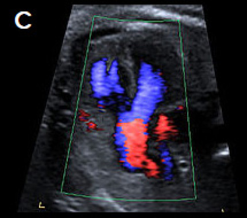 Ultrasound showing Tetralogy of Fallot