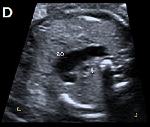 Ultrasound showing Tetralogy of Fallot