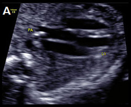 Ultrasound showing transposition of the great arteries