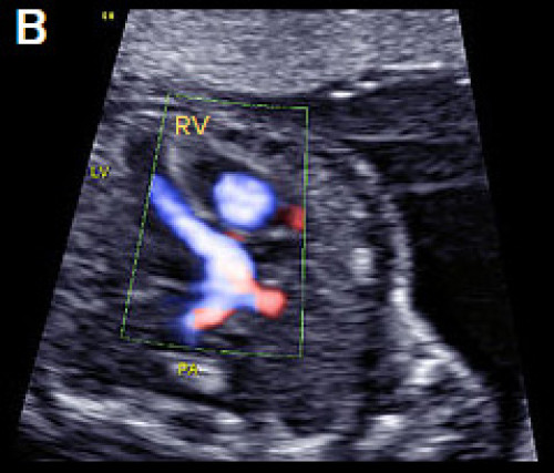 Ultrasound showing transposition of the great arteries