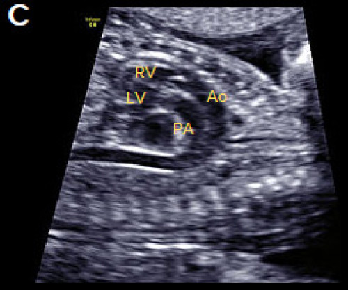 Ultrasound showing transposition of the great arteries