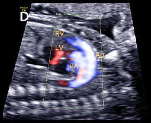 Ultrasound showing transposition of the great arteries