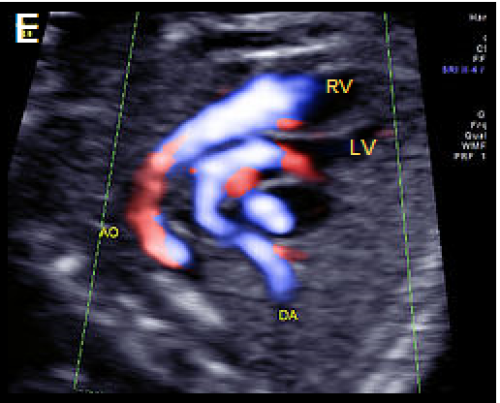 Ultrasound showing transposition of the great arteries