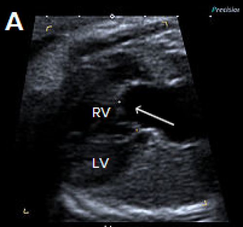 Common arterial trunk ultrasound image