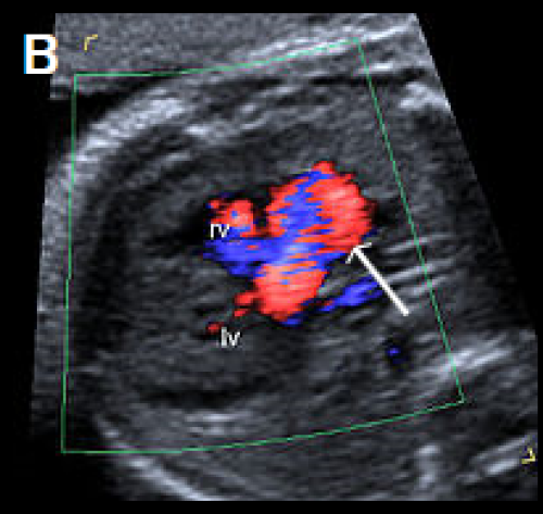 Common arterial trunk ultrasound image