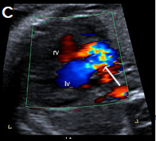 Common arterial trunk ultrasound image