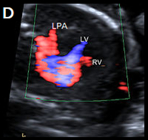 Common arterial trunk ultrasound image