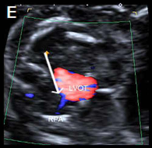 Common arterial trunk ultrasound image