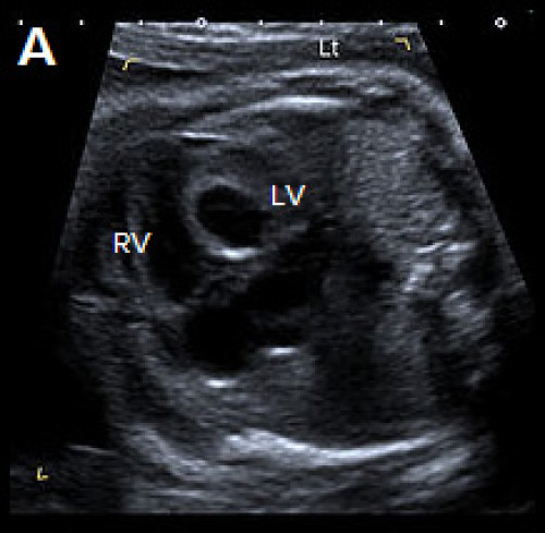 Abnormal small LV on the 4Ch view with an echogenic inner wall in keeping with endocardial fibroelastosis. 