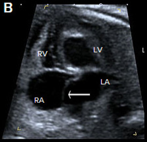 Abnormal small LV on the 4Ch view with an echogenic inner wall in keeping with endocardial fibroelastosis. 