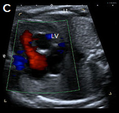Abnormal small LV on the 4Ch view with an echogenic inner wall in keeping with endocardial fibroelastosis. 
