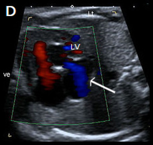 Abnormal small LV on the 4Ch view with an echogenic inner wall in keeping with endocardial fibroelastosis. 