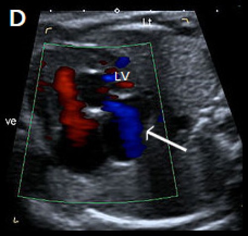 Abnormal small LV on the 4Ch view with an echogenic inner wall in keeping with endocardial fibroelastosis.