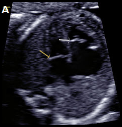 Normal mitral valve position (yellow arrow), in diastole (A)