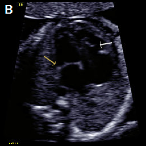 Normal mitral valve position (yellow arrow) with the valve leaflets open (B)