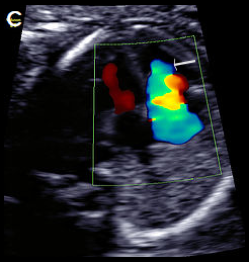 On colour Doppler imaging, there is a large tricuspid regurgitant jet arising from the mid-apical RV