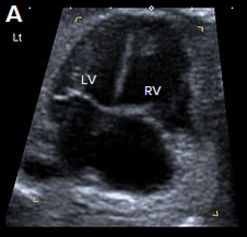 4Ch heart view showing narrower LV compared with the RV, on greyscale imaging (A)
