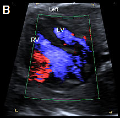 4Ch heart view showing narrower LV compared with the RV and with a narrower colour strip and patent AV valves on colour Doppler imaging (B).