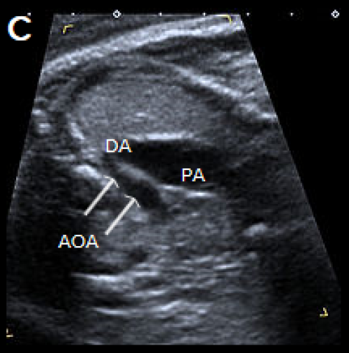 3-vessel view in two different fetuses with coarctation 