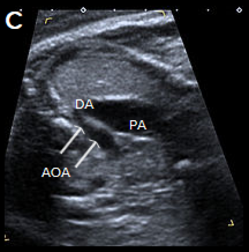 3-vessel view in two different fetuses with coarctation