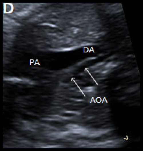 narrow aortic arch compared with the PA