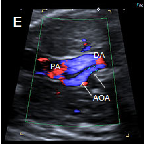 Colour Doppler confirms the narrow calibre of the aortic arch compared with the PA