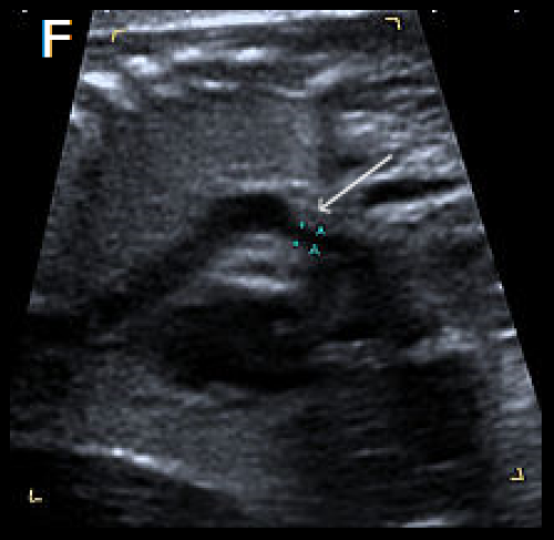 Sagittal views of the aortic arch in greyscale