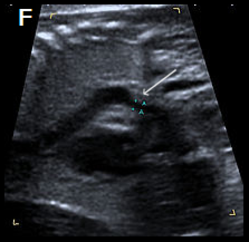 Sagittal views of the aortic arch in greyscale 