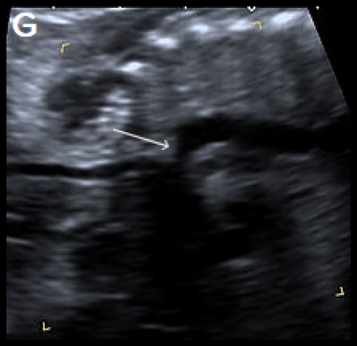 Sagittal views of the aortic arch in greyscale