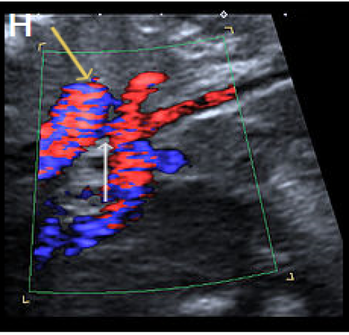 Sagittal views of the aortic arch in colour