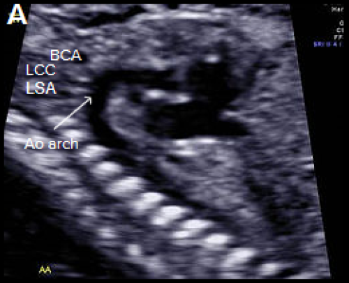 Ultrasound showing interruption of the aortic arch 