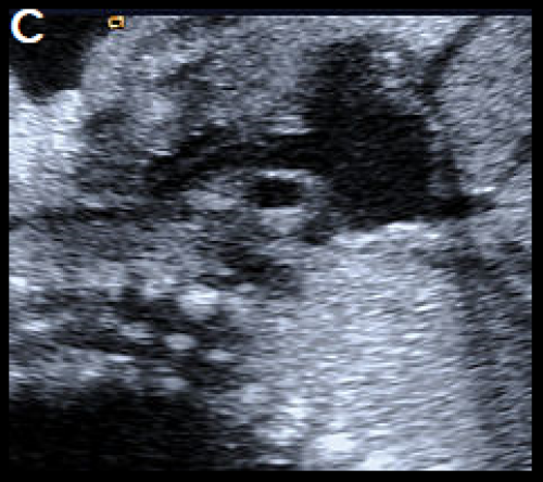 Ultrasound showing interruption of the aortic arch