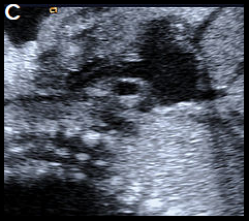 Ultrasound showing interruption of the aortic arch 