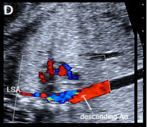 Ultrasound showing interruption of the aortic arch
