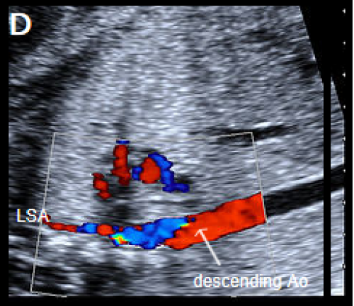 Ultrasound showing interruption of the aortic arch 