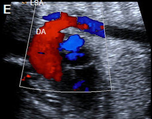Ultrasound showing interruption of the aortic arch 