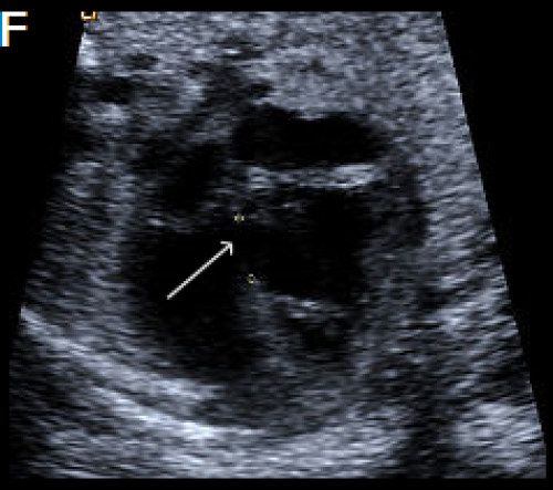 Ultrasound showing interruption of the aortic arch